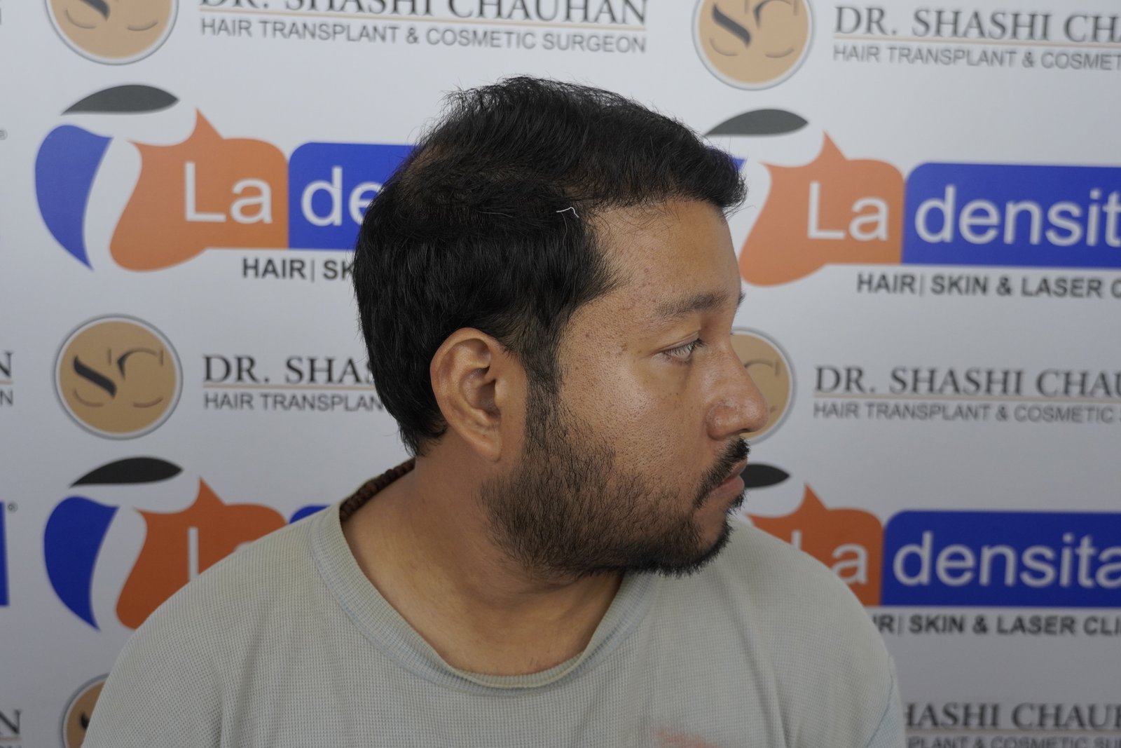Dr. Bishal After Hair Transplant